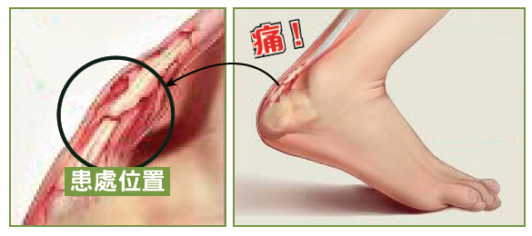 阿基里斯跟腱